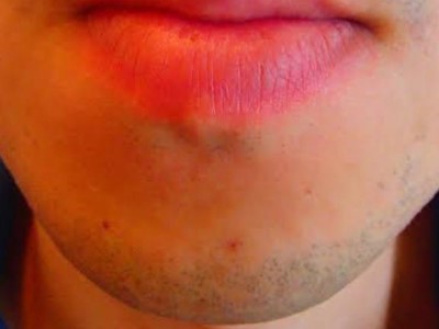 あごひげ脱毛Before