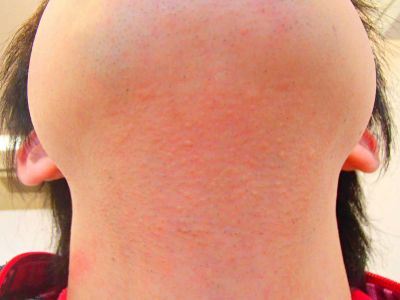 あごひげ裏脱毛After