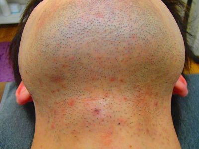 あご裏ひげ脱毛Before