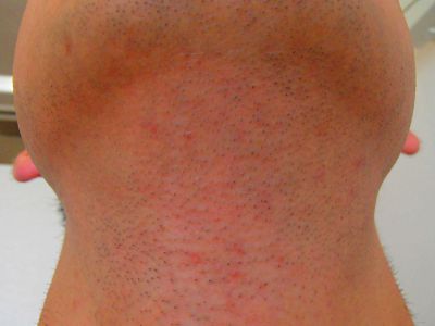 首ひげ脱毛Before