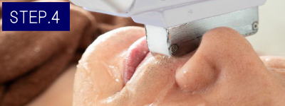 首ひげ脱毛Step4