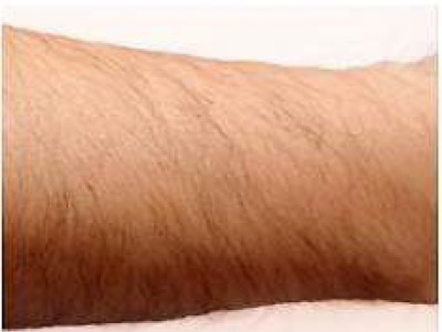 ひじ下脱毛Before