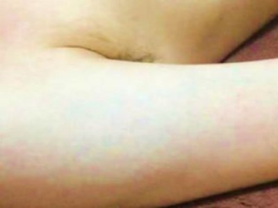 ひじ上脱毛After
