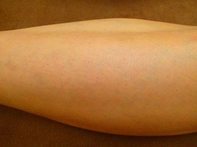 ひざ下脱毛After