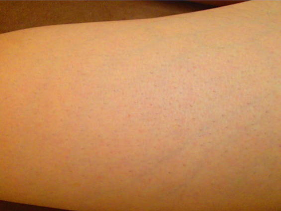 ひざ上脱毛After