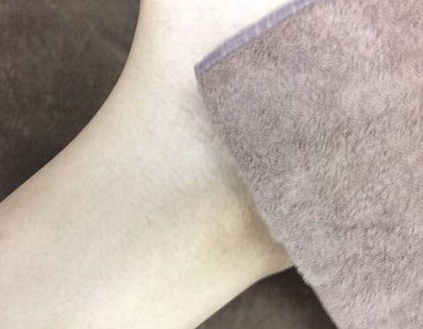 Vライン脱毛After