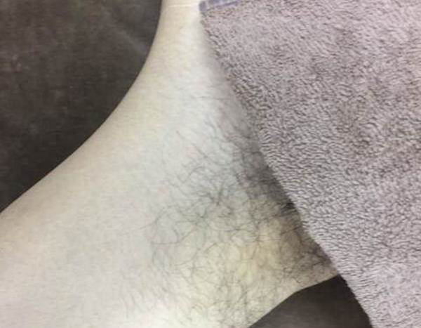 Vライン脱毛Before