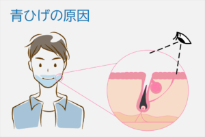 青ひげになる原因