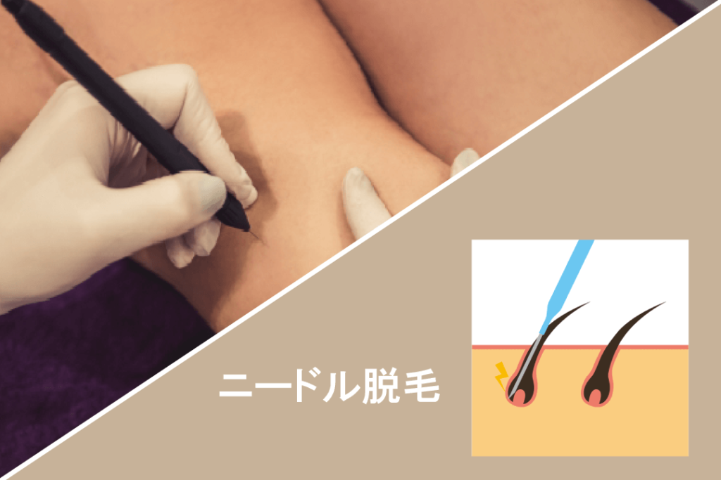 脱毛方法①ニードル脱毛