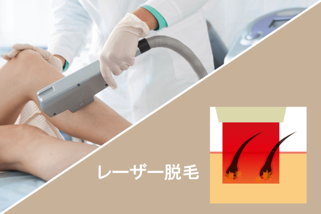 レーザー脱毛について