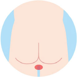 Iライン脱毛の範囲