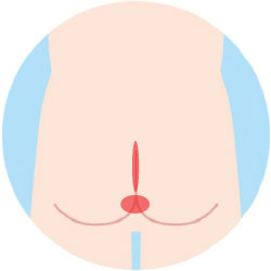 Oライン脱毛Before