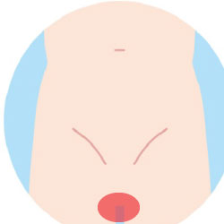 Vライン脱毛Before